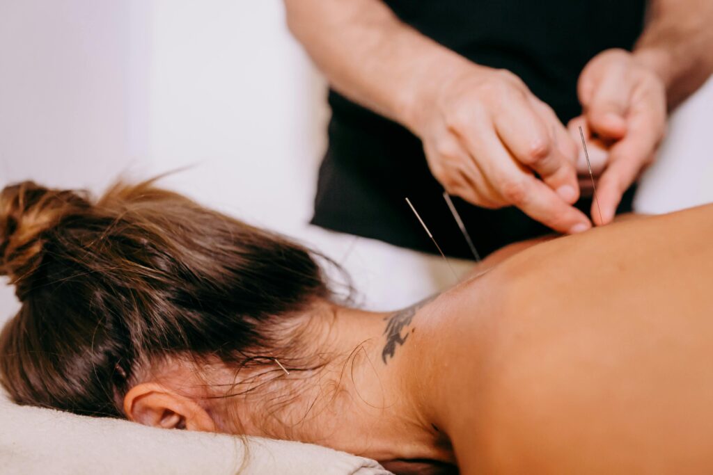 Patient receiving dry needling treatment on the neck and upper back for migraine relief